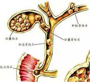 可接下来的检查发现,老人还患有慢性胆囊炎,糖尿病等多种病症.